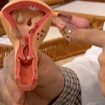 pesquisas sobre endometriose